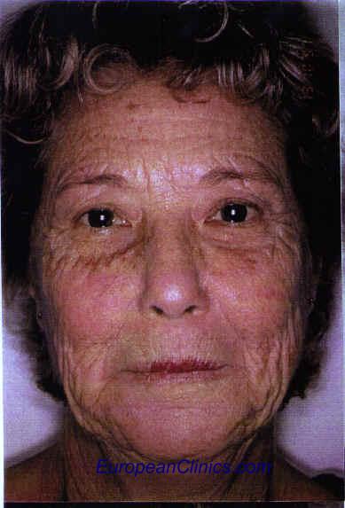 Exolift perles face avant.BMP (669318 octets)