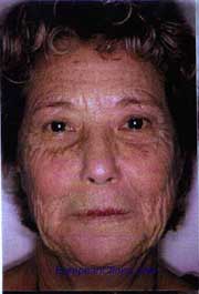 Exolift perles face avant.BMP (669318 octets)